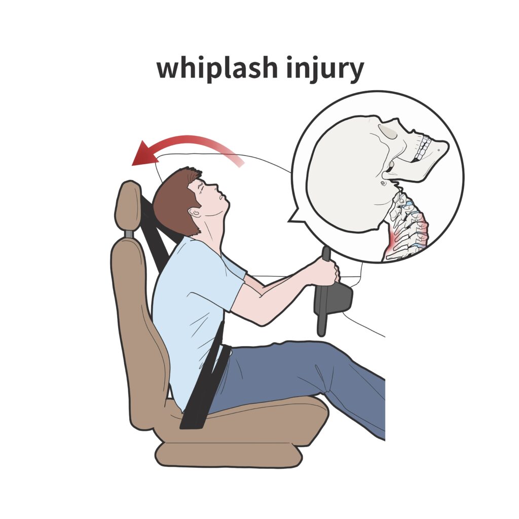 How Much Is Whiplash Worth in a Lawsuit