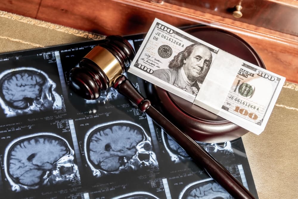 Brain Injury Compensation Claim